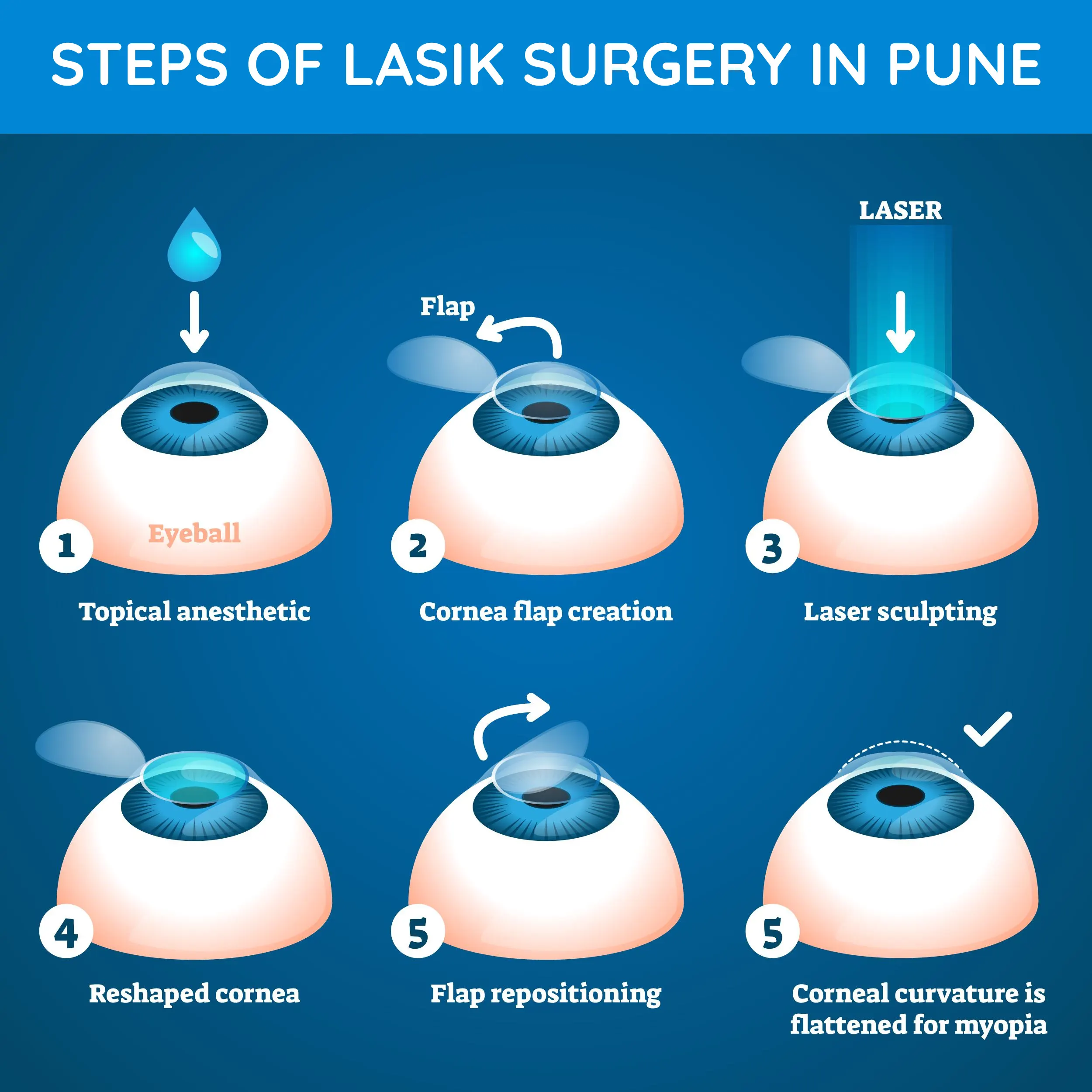 steps of bladeless femtosecond lasik surgery